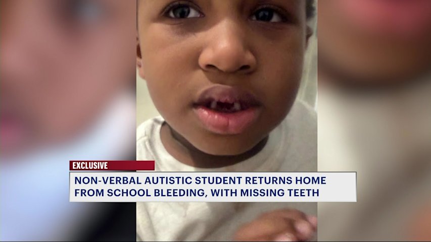 Video thumbnail for 'His voice is not heard.’ Non-verbal Brooklyn child comes home from school with missing teeth, bloody shirt