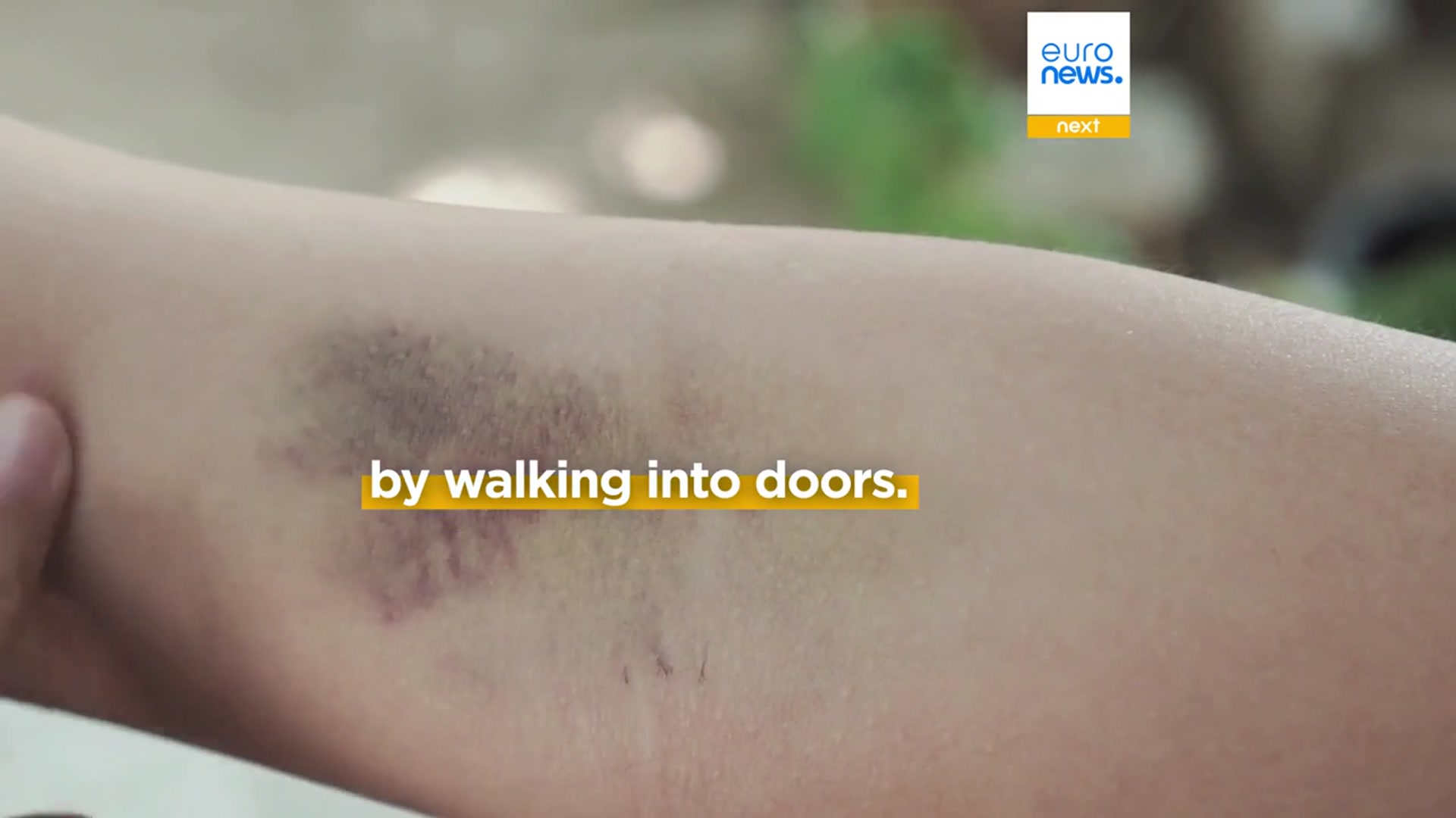 'Video thumbnail for This is the world’s first entire arm exoskeleton, giving stroke patients more ‘independence''