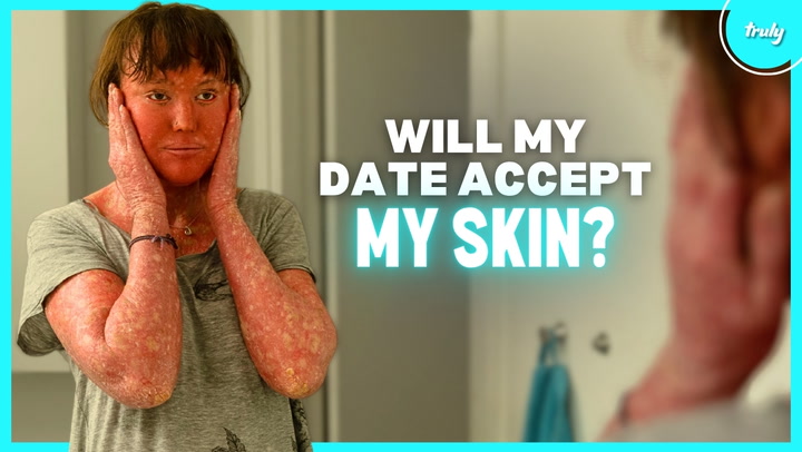 Video thumbnail for People Avoid Me Because Of My Skin - Will My Blind Date? | BORN DIFFERENT