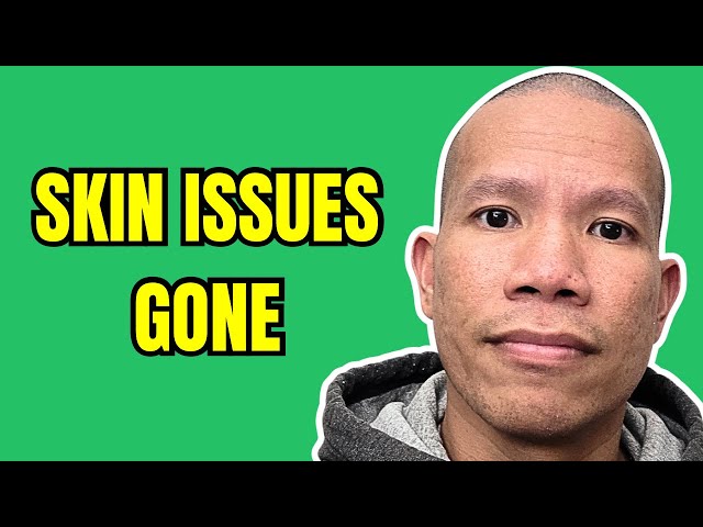 Video thumbnail for Psoriasis. Eczema. Pain. Gone. Here’s What He Did…