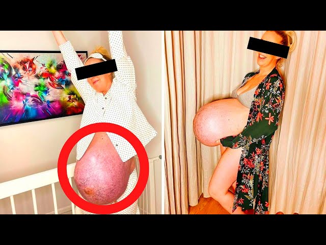 Video thumbnail for Doctor Shocked When He Found Out Why This Pregnant Woman Baby Bump Was Strangely Huge !