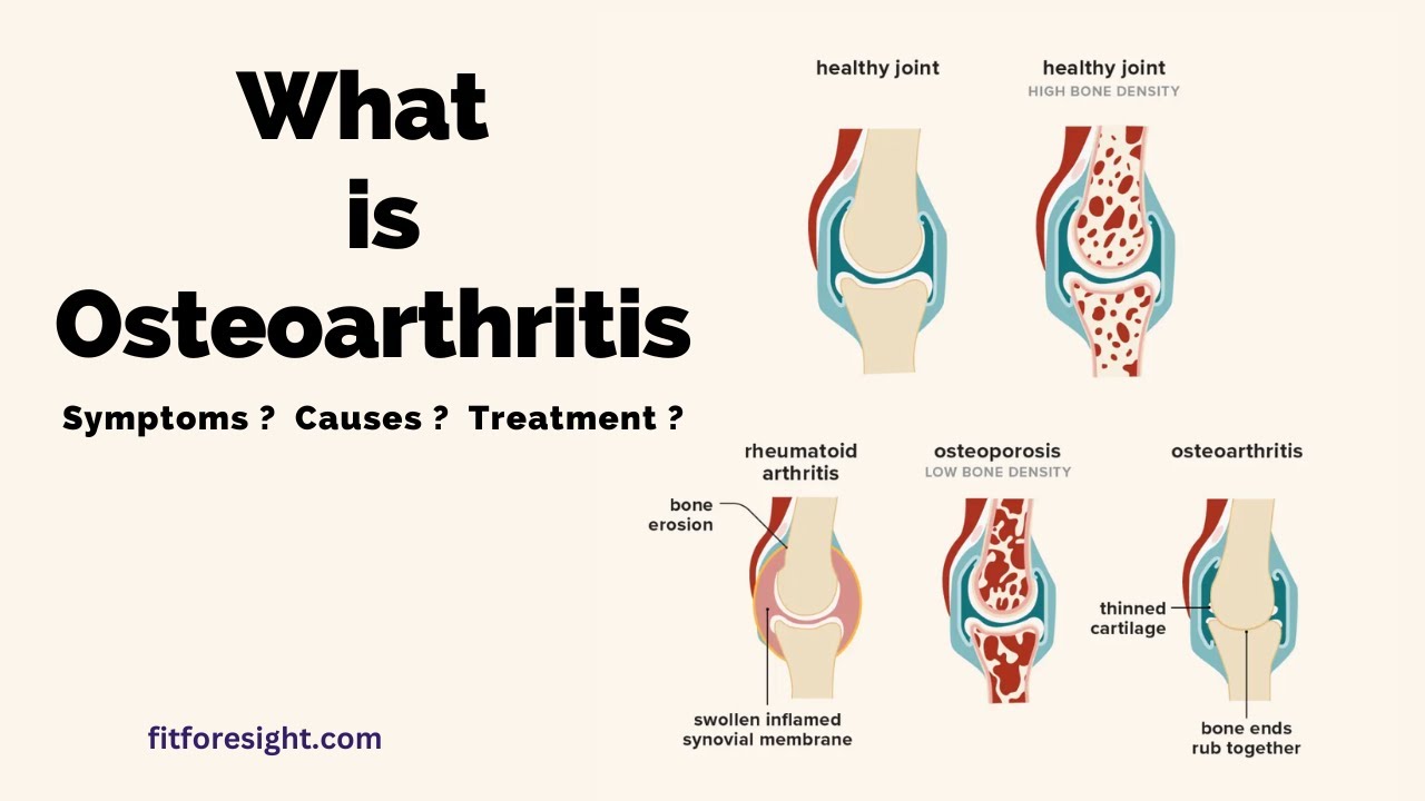 Video thumbnail for What is Osteoarthritis ? Symptoms , Causes , Treatment .