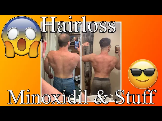 Video thumbnail for Riffin' On Hair Loss (Minoxidil: Does it REALLY work, what to expect, good practices, other stuff.)