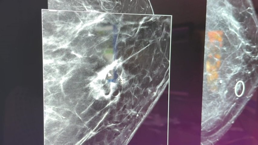 Video thumbnail for Tiny speck, big warning: Floral Park woman’s mammogram detects cancer no one could see or feel