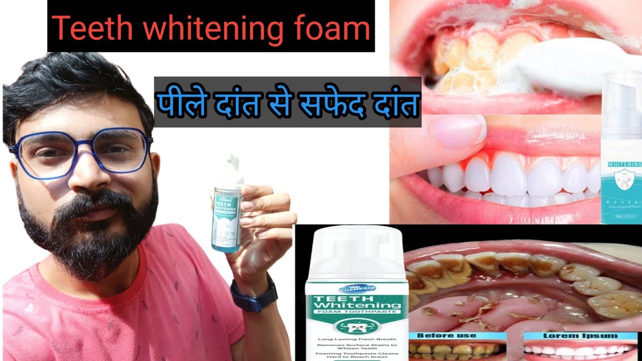 Video thumbnail for Teeth Whitening FoamToothpaste Review/ Yellow Teeth Solution लेने से पहले यह विडियो जरूर देखे