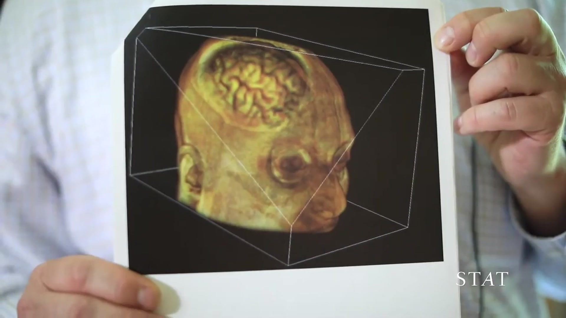 'Video thumbnail for Meet a man whose brain went viral before the Internet existed'