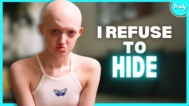 Video thumbnail for My Rare Condition Took My Hair & Teeth | BORN DIFFERENT