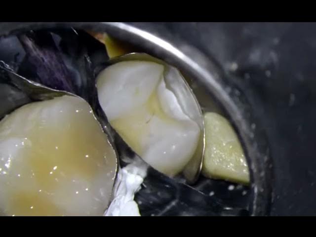 Video thumbnail for Injection Molding Technique in Class II Composite Restorations | Clinical Demonstration