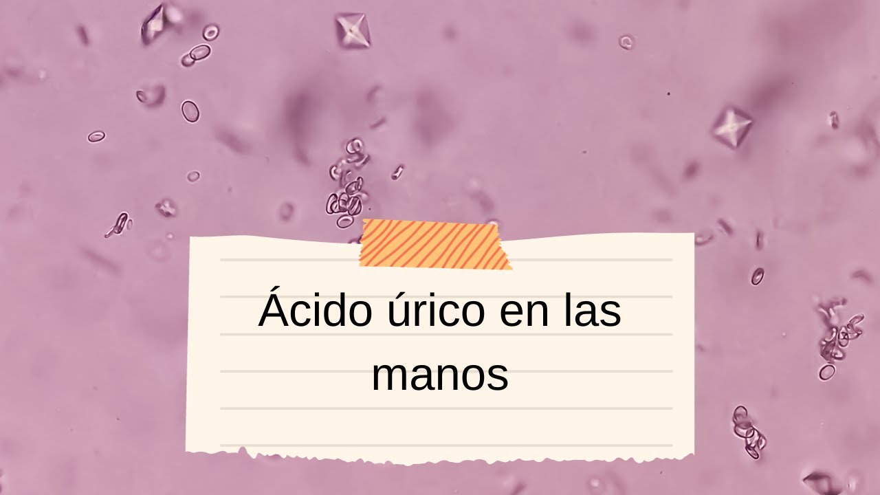 'Video thumbnail for Ácido úrico en las manos: video blog'