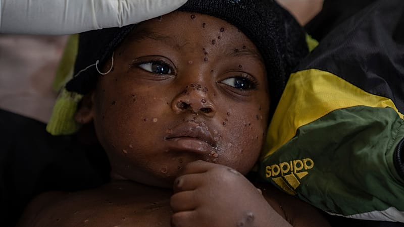 Video thumbnail for First-ever mpox cases reported in Guinea-Bissau with children the most vulnerable