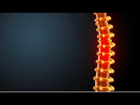 'Video thumbnail for ¿Qué es la Artrosis Lumbar y Cómo Afecta tu Calidad de Vida?'