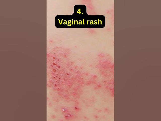 Video thumbnail for 7 Warning Signs You Have A Yeast Infection