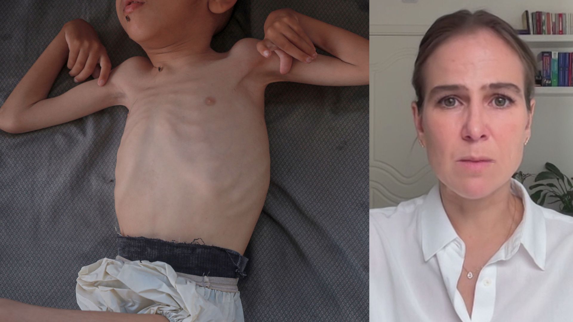 'Video thumbnail for Doctor explains why refeeding malnourished patients can be life-threatening'