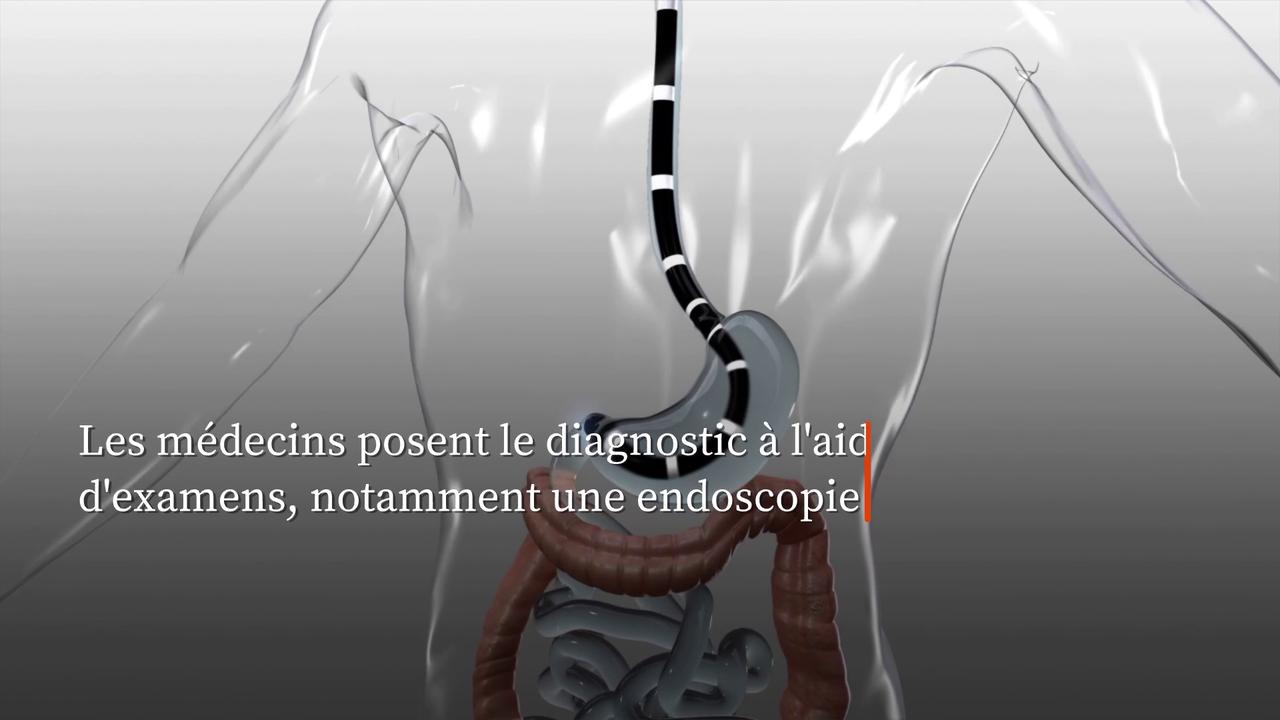 Video thumbnail for Kim Kardashian souffre d'une œsophagite.