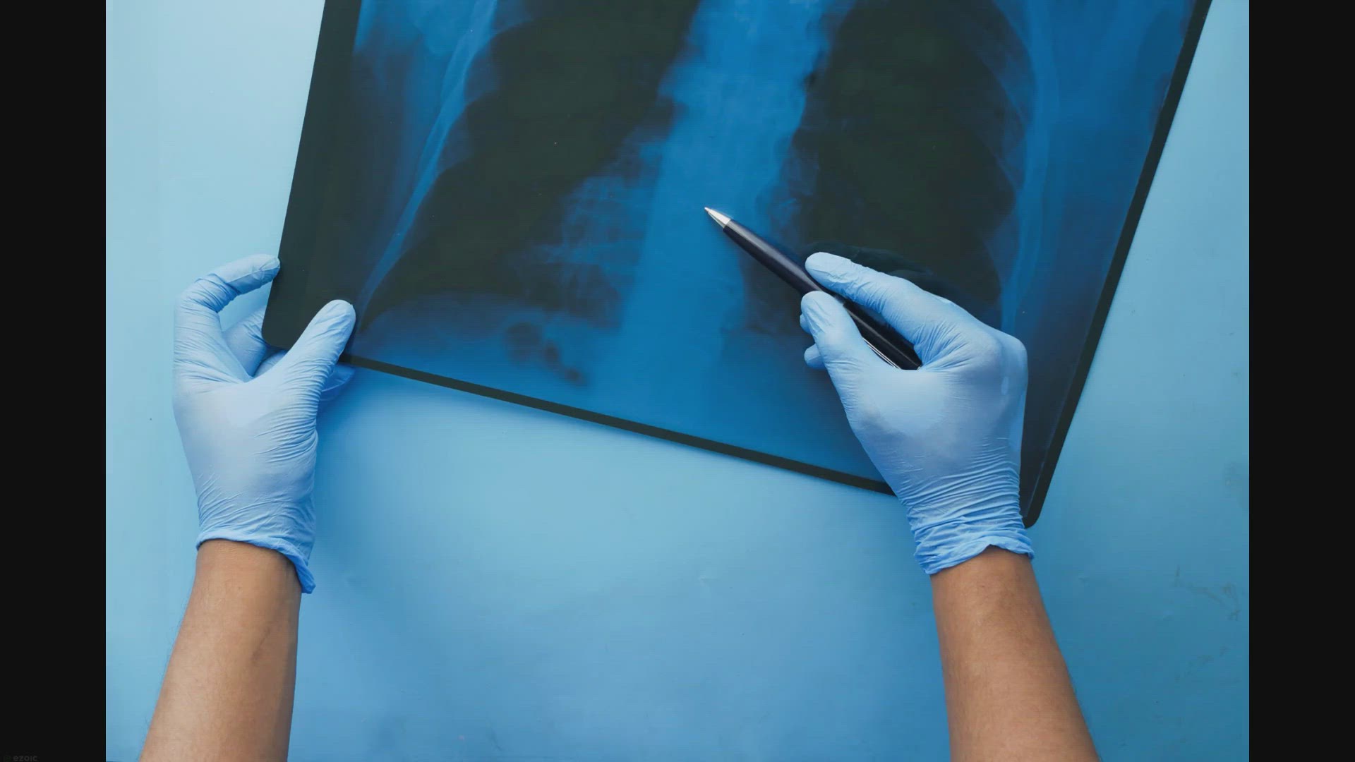 Video thumbnail for ¿Una Lesión de Espalda con Cirugía es un Caso Millonario en Estados Unidos?