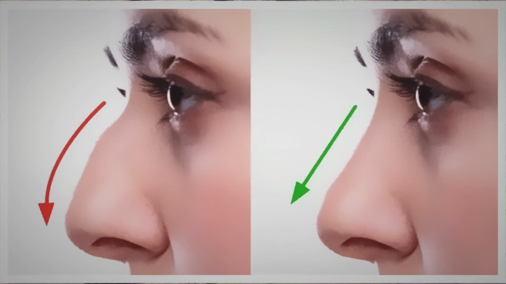 'Video thumbnail for Unveiling the Artistry of Rhinoplasty in Dubai: A Nose Job Like No Other'