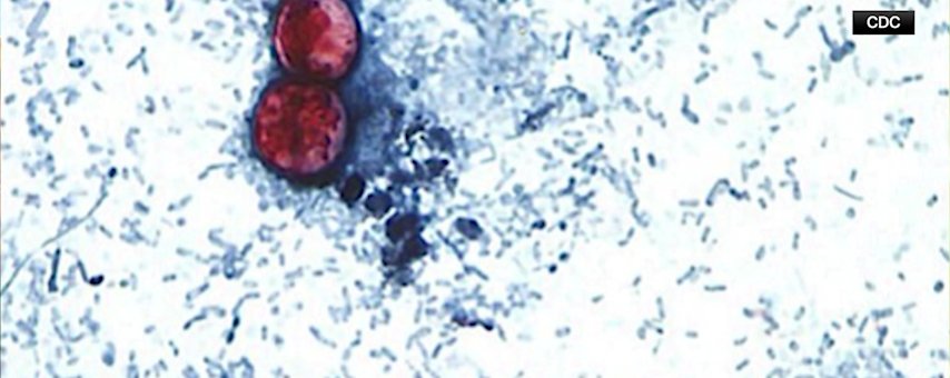 Video thumbnail for Up to 200 cyclosporiasis cases reported in New Jersey