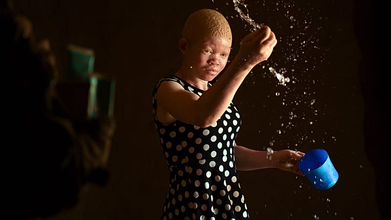 Video thumbnail for People with albinism get free cancer screening in Kenya