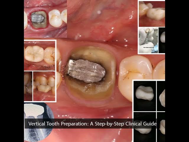 Video thumbnail for Vertical Tooth Preparation in Prosthodontics | Dentistry Simplified Ep.2