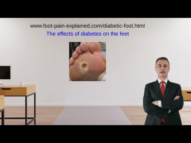 Video thumbnail for Diabetes and the foot