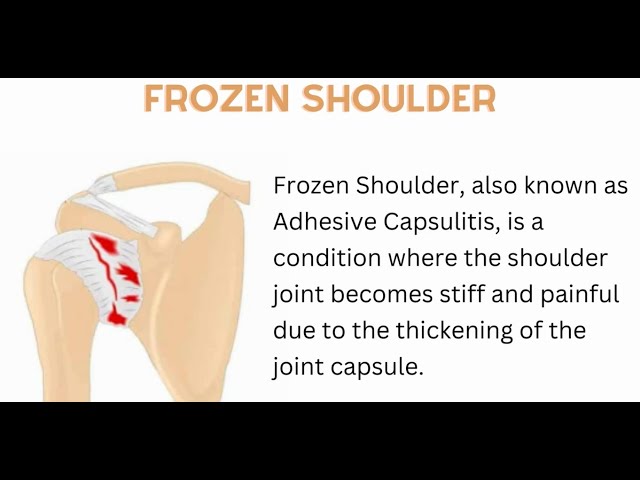 Video thumbnail for Frozen Shoulder, Adhesive Capsulitis
