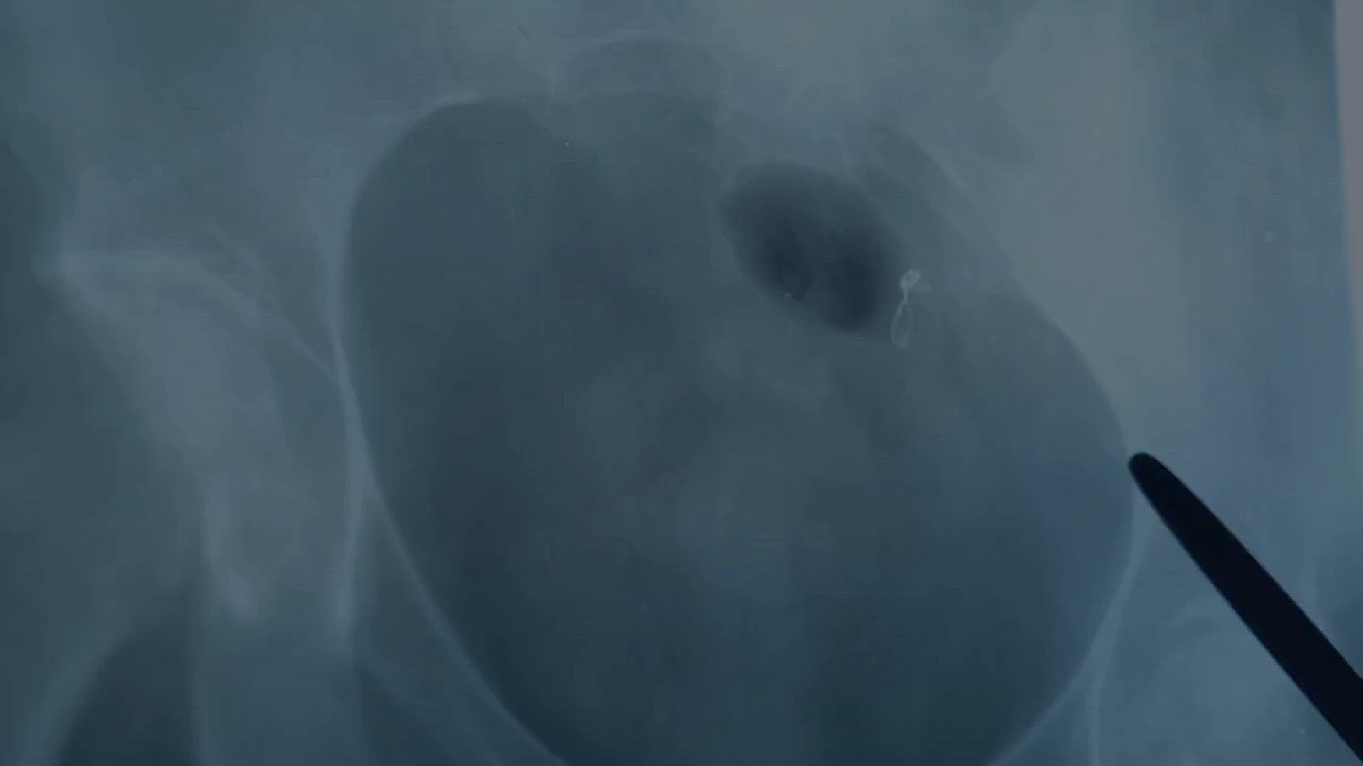 'Video thumbnail for Kidney Stones 10 Warning Signs You Absolutely Cannot Ignore'
