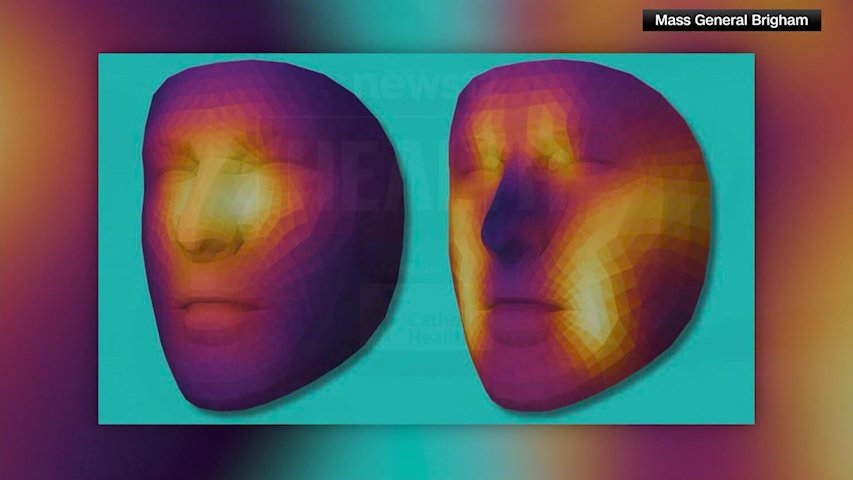 Video thumbnail for New AI model estimates cancer survival rate based on face photos