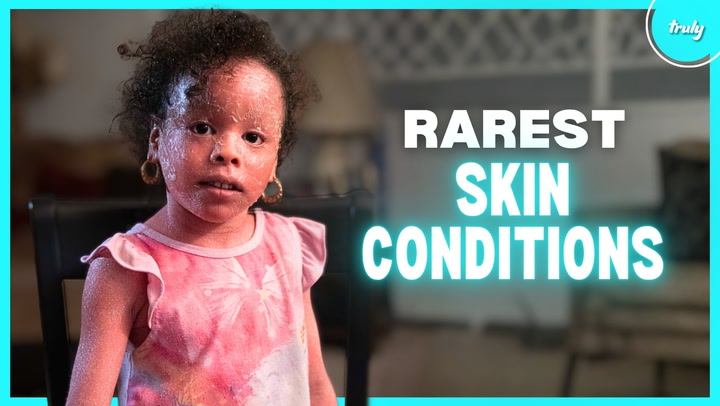Video thumbnail for The Most Extreme Skin Conditions In The World | BORN DIFFERENT