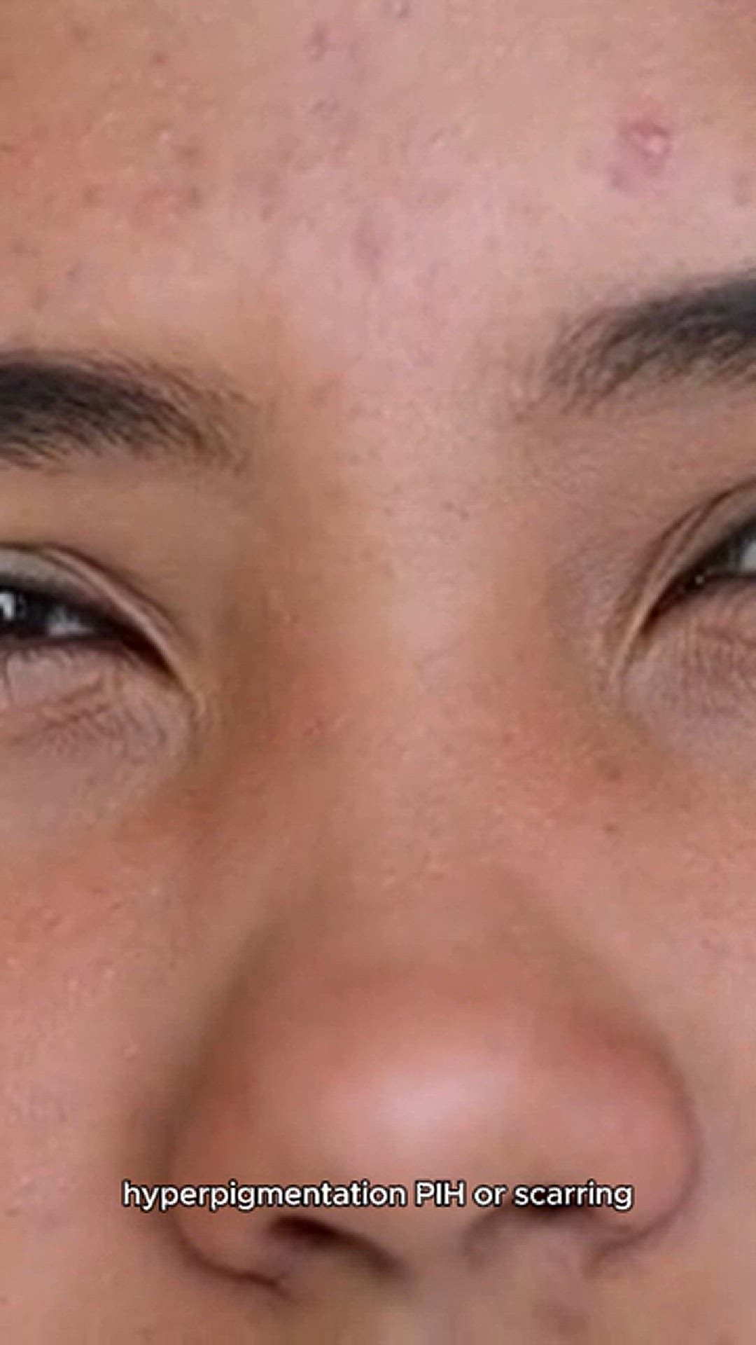 Video thumbnail for tips for acne mark removal