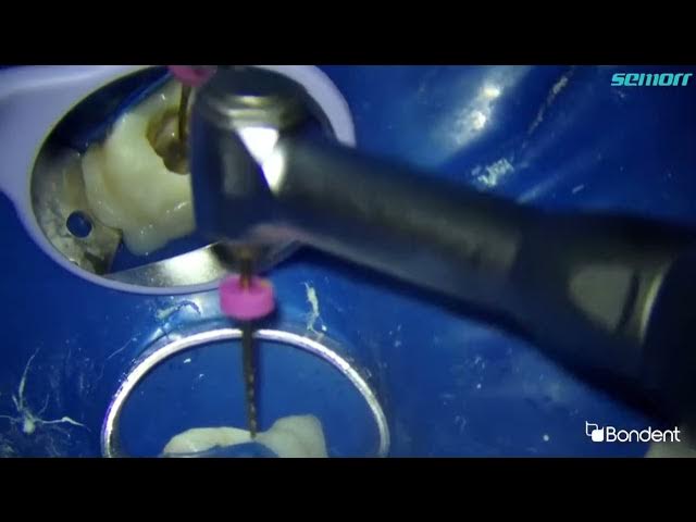 Video thumbnail for ENDO: Bondent M3 Pro Gold🎉 Caso Clínico con el Dr. Palestino ABDELKAREEM