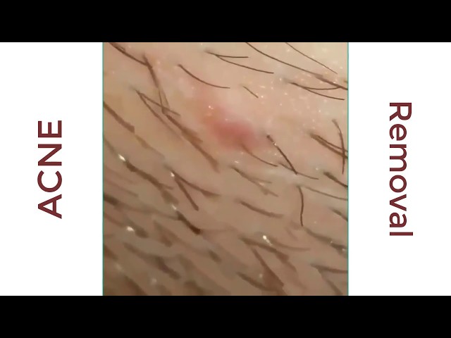 Video thumbnail for Acne treatment blackheads and whiteheads