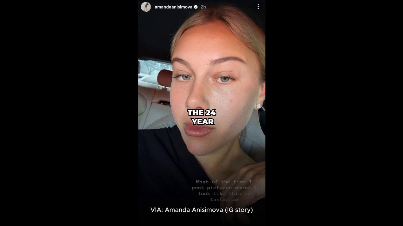 Video thumbnail for Amanda Anisimova dispels Instagram beauty standards with unedited pics of her acne struggles ✨