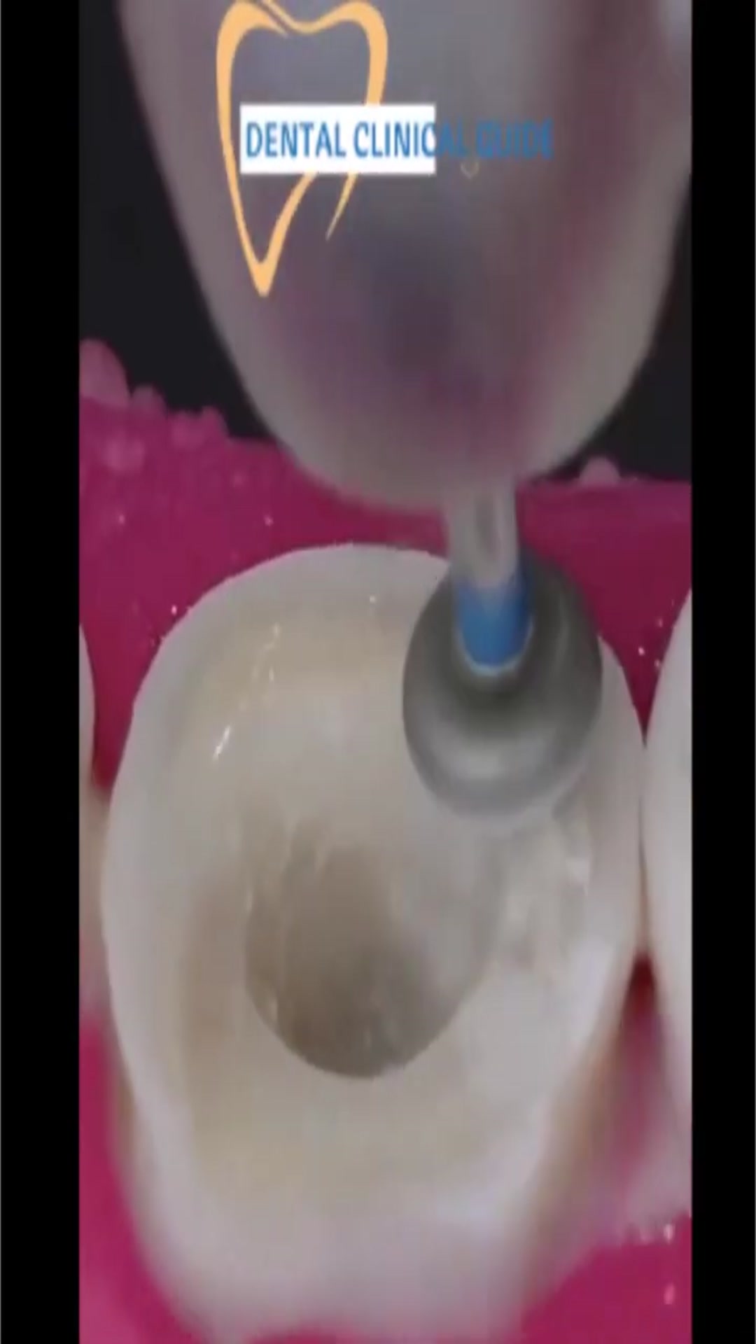 Video thumbnail for Endocrown Preparation: Step-by-Step Demo