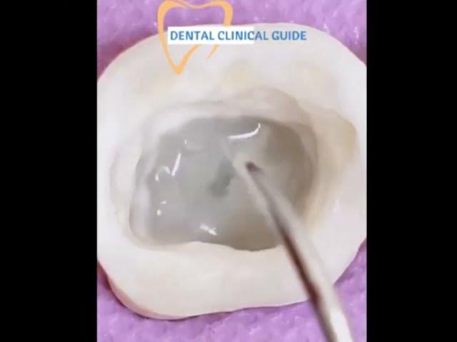 Video thumbnail for Endocrown Preparation: Step-by-Step Demo