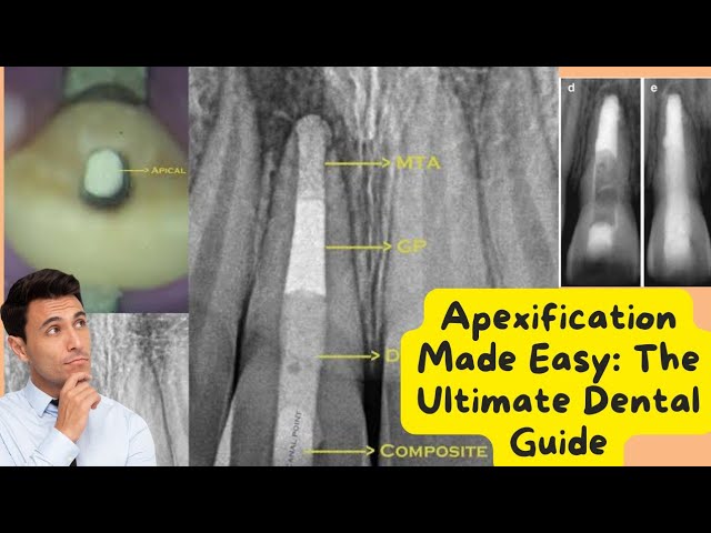 apexification procedure : a clinical guide step by step | Open Video