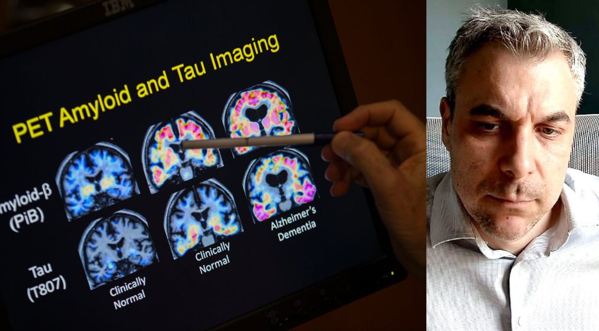 Video thumbnail for Can dementia be prevented? Expert explains key risk factors and warning signs