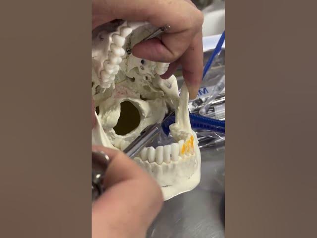 Video thumbnail for inferior alveolar nerve block #dentaleducation #dentalhealth #dentalartistry #dentalprosthesis