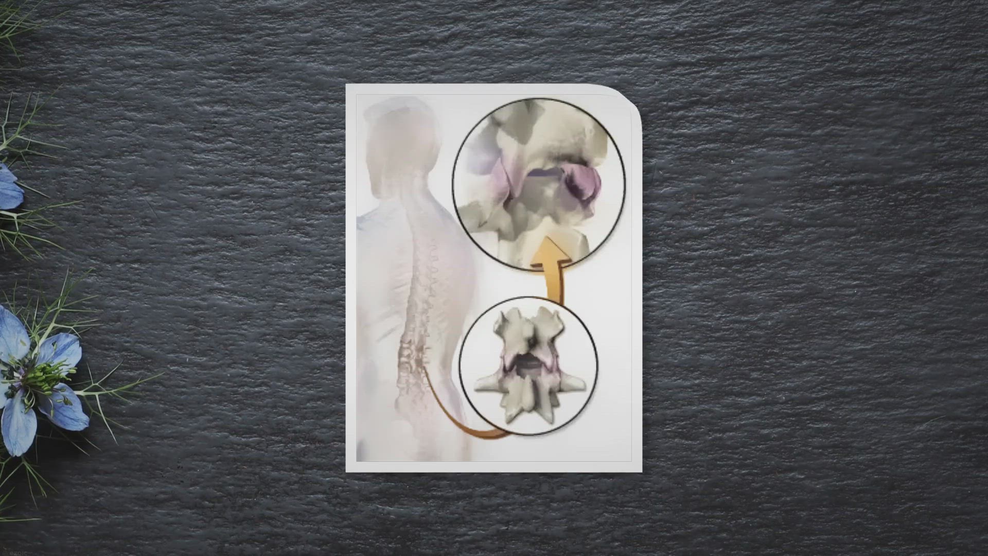 'Video thumbnail for Arthrose zygapophysaire: Cause de vos douleurs? (Que faire?)'