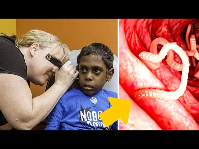 Video thumbnail for They Thought He Had A Piece Of Pencil In His Ear - Then The Doctor Gasps Seeing This Inside !