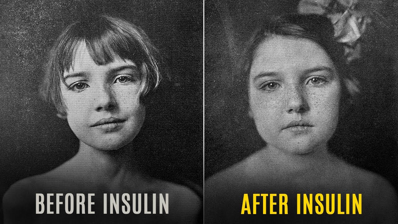 Video thumbnail for The First Use of Insulin was in 1922 and It Has an Amazing Story Behind It!