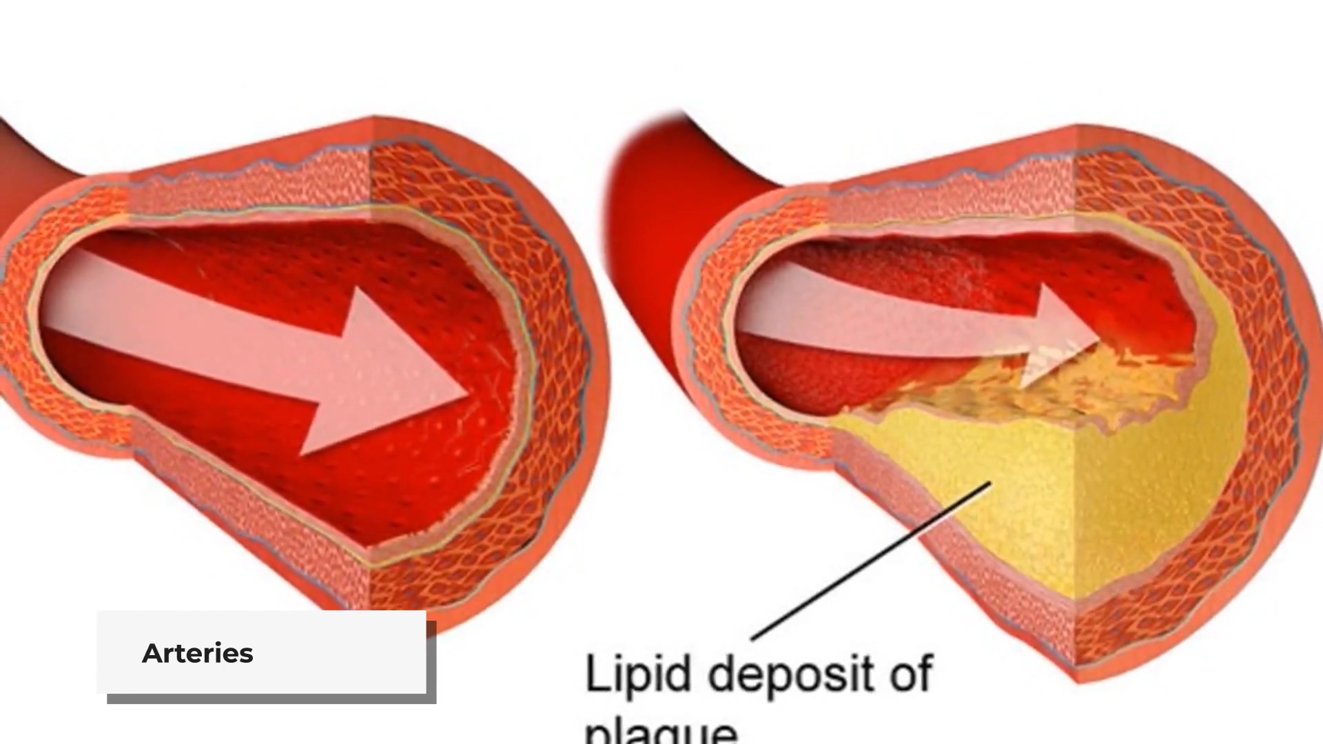 video of: Signs of Clogged Arteries: 10 Early Warnings You Need to Know