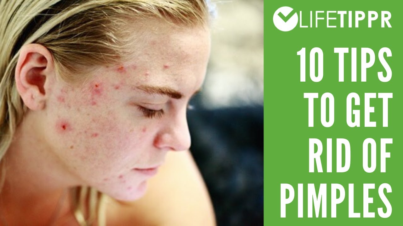 Video thumbnail for Top 10 Tips To Remove Acne (Pimples) and Blackheads
