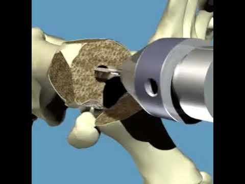 Video thumbnail for Bunion correction by total joint implant #education #doctor #motivation