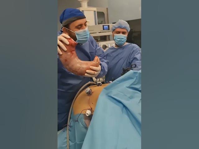 Video thumbnail for عملية تكميم المعدة البنج النصفي شاهد العملية والنتيجة