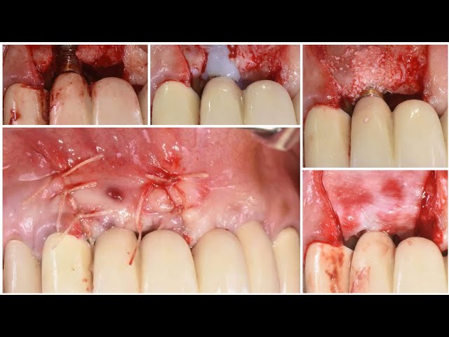 Video thumbnail for Peri-implantitis Management: A Step-by-Step Clinical Case