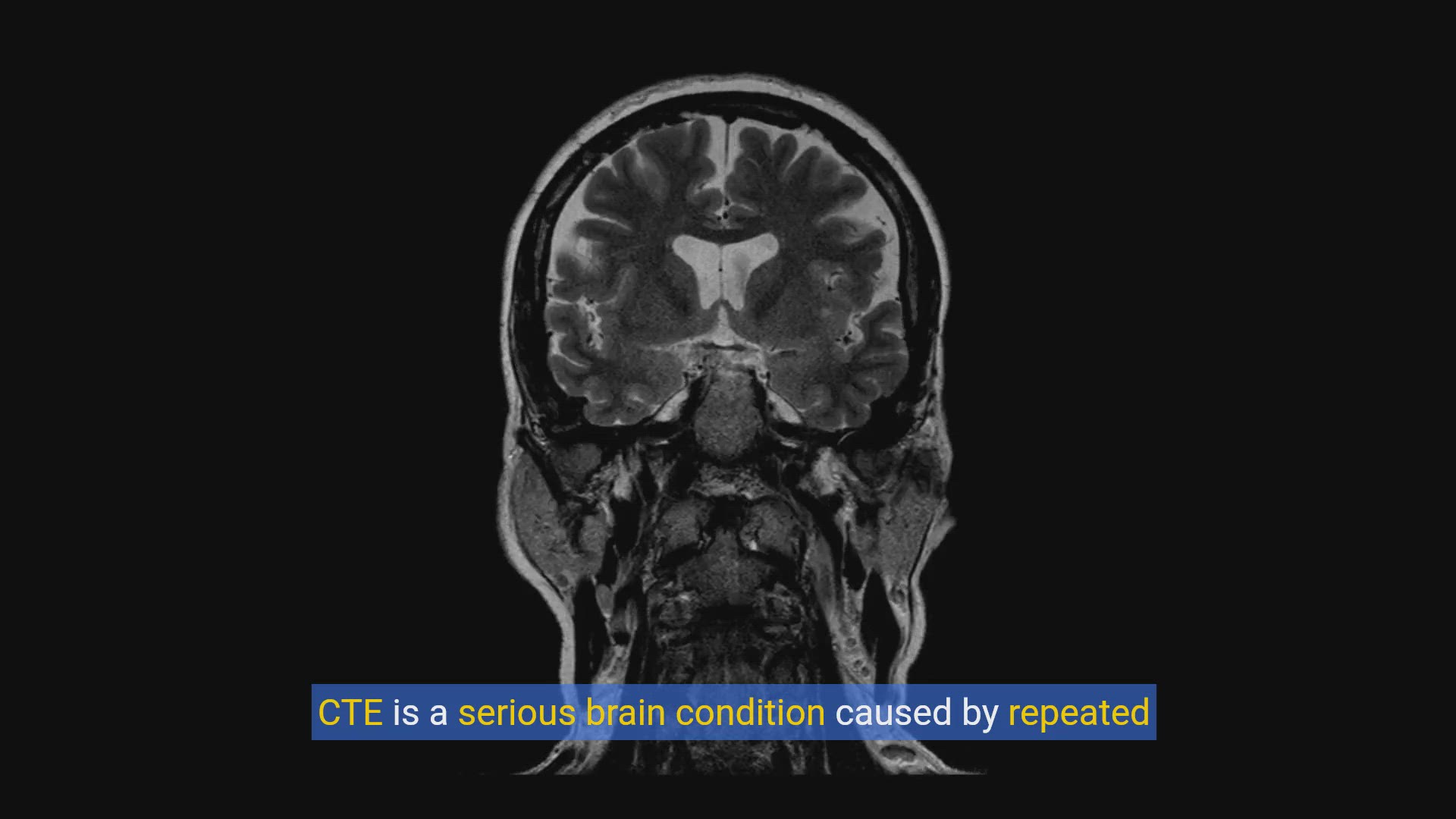 'Video thumbnail for Recognizing the Warning Signs of CTE: Symptoms and Early Detection'