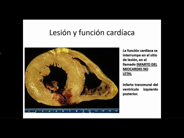 Video thumbnail for Lesion y reparacion musculo cardiaco Marisol Barrientos Chacon