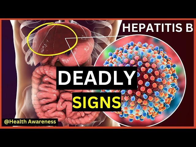 Video thumbnail for Signs And Symptoms Of Hepatitis B You Must Not Ignore || Everything You Need To Know