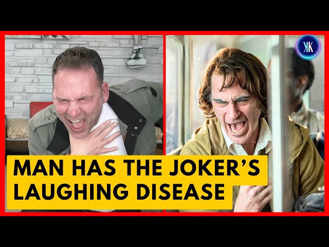 Video thumbnail for This Man Has The Same Laughing Disease As The Joker