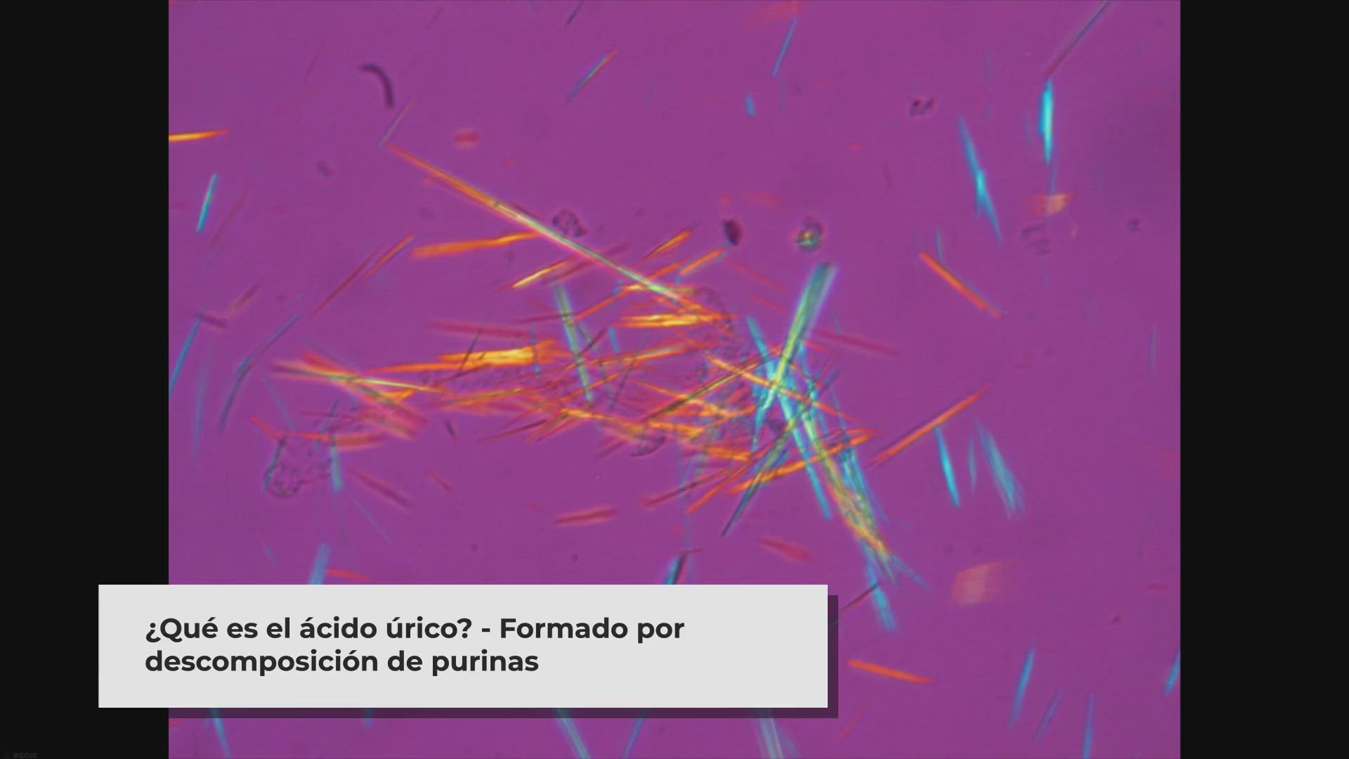 'Video thumbnail for Síntomas de Ácido Úrico Alto en Mujeres: ¿Cómo Identificarlo? video'